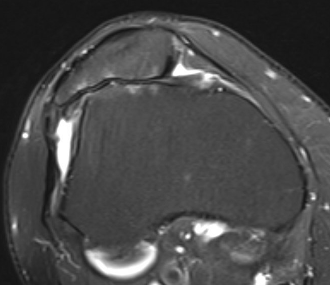 PFJ Osteoarthritis The Bone School pfj-osteoarthritis-the-bone-school